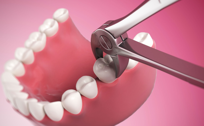 Extractions and Bone Grafting