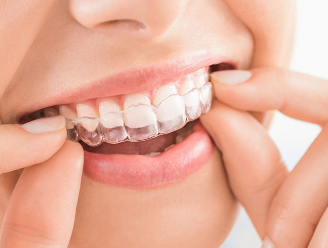 Invisalign Treatment